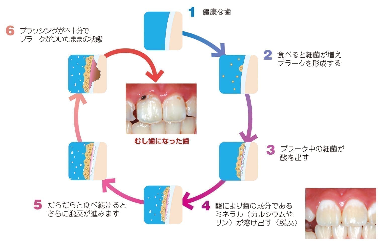虫歯のメカニズム