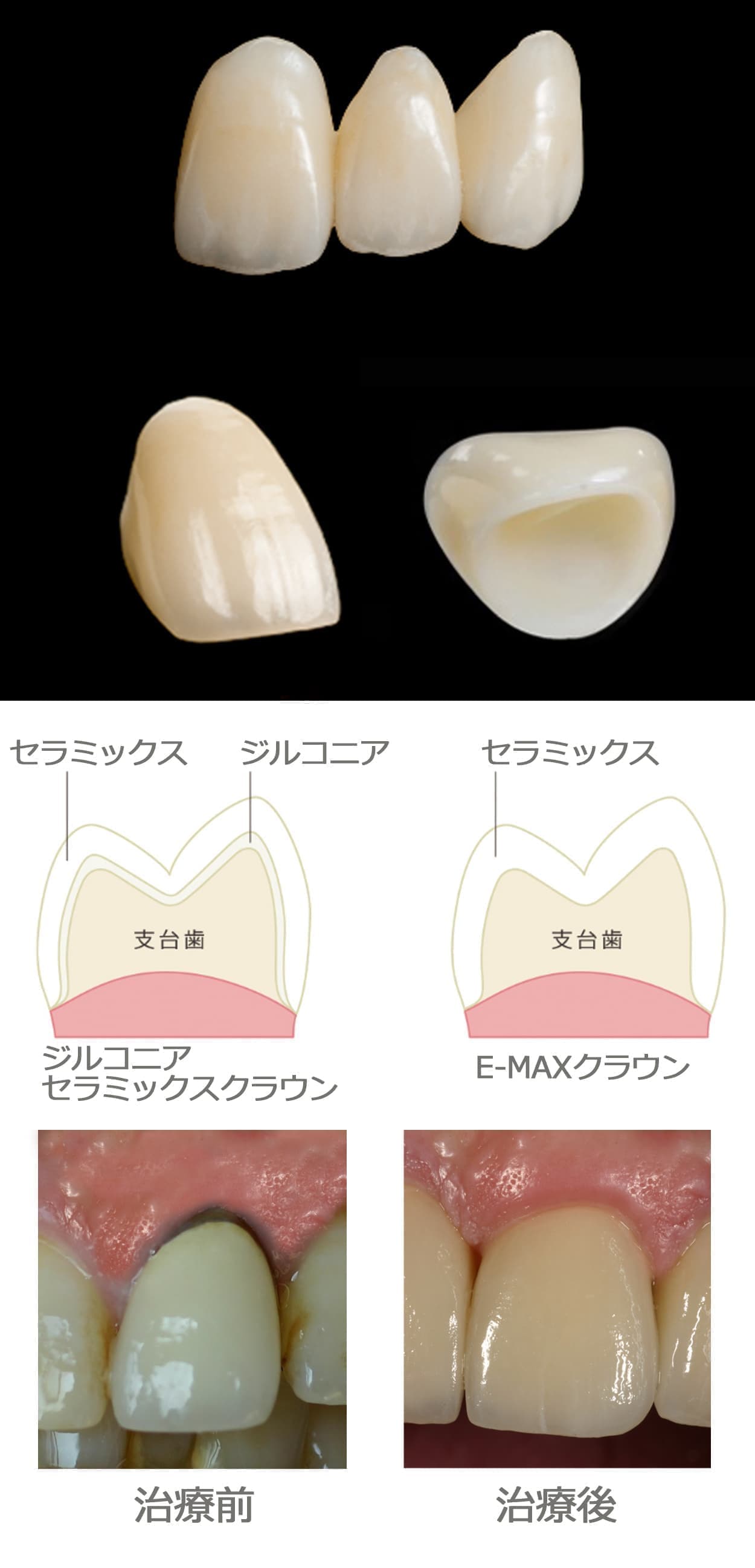 オールセラミックスクラウン