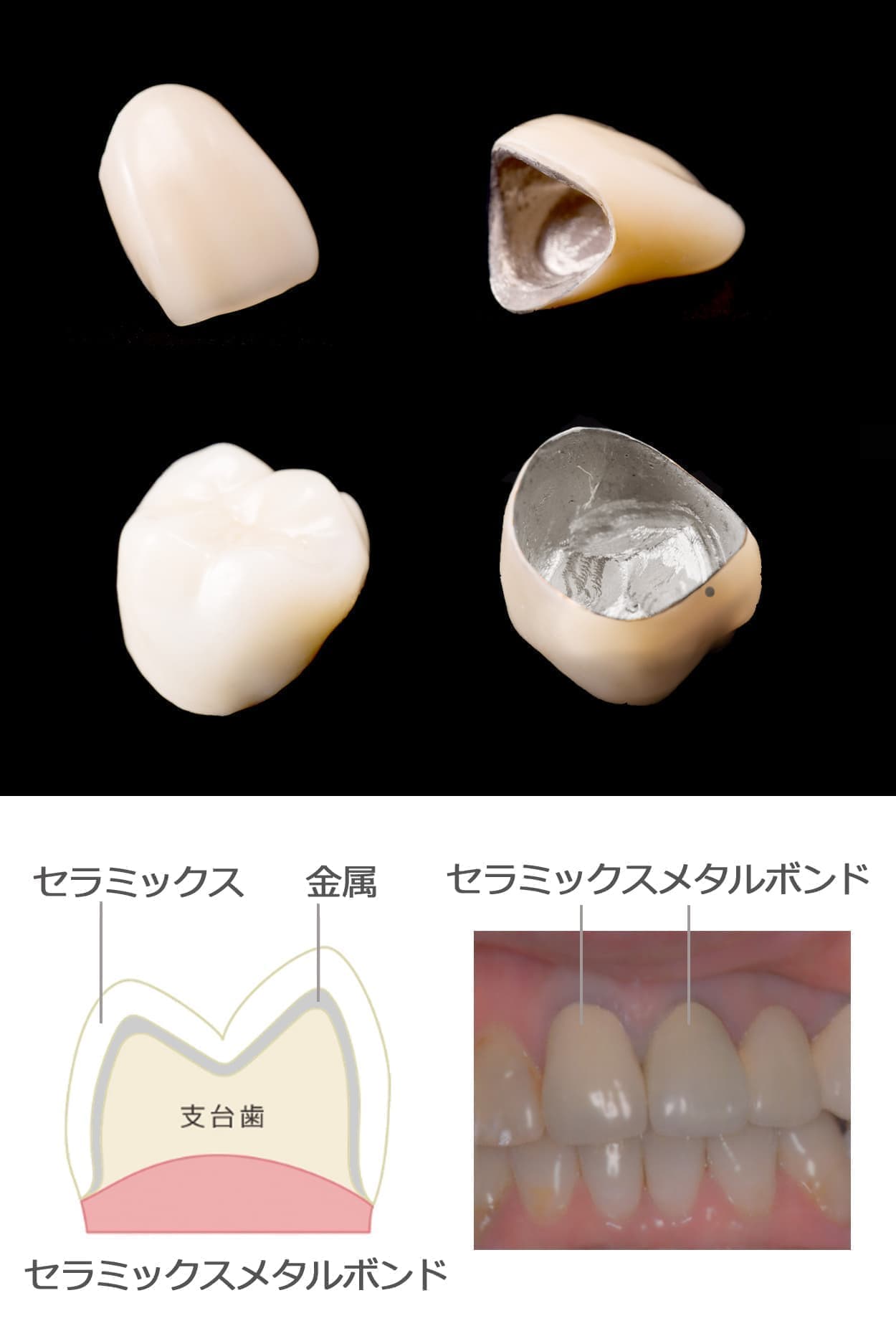 セラミックメタルボンドクラウン