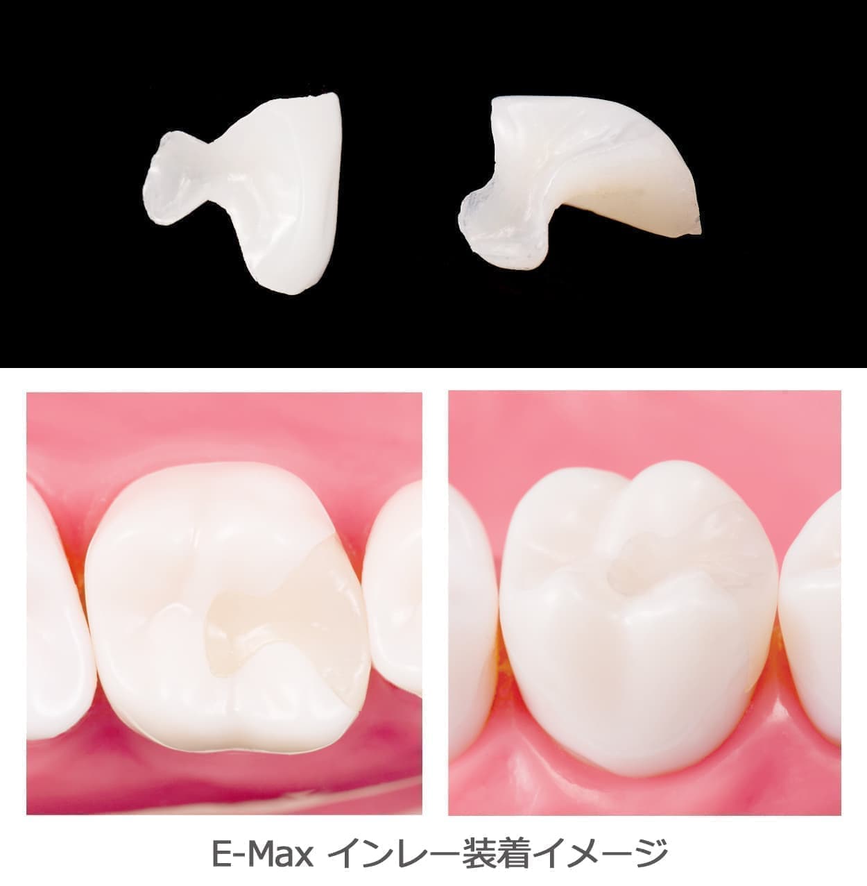 E-Maxインレー