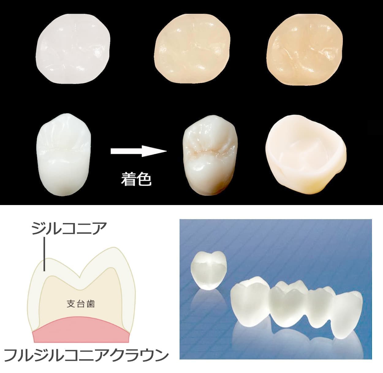 ジルコニアクラウン