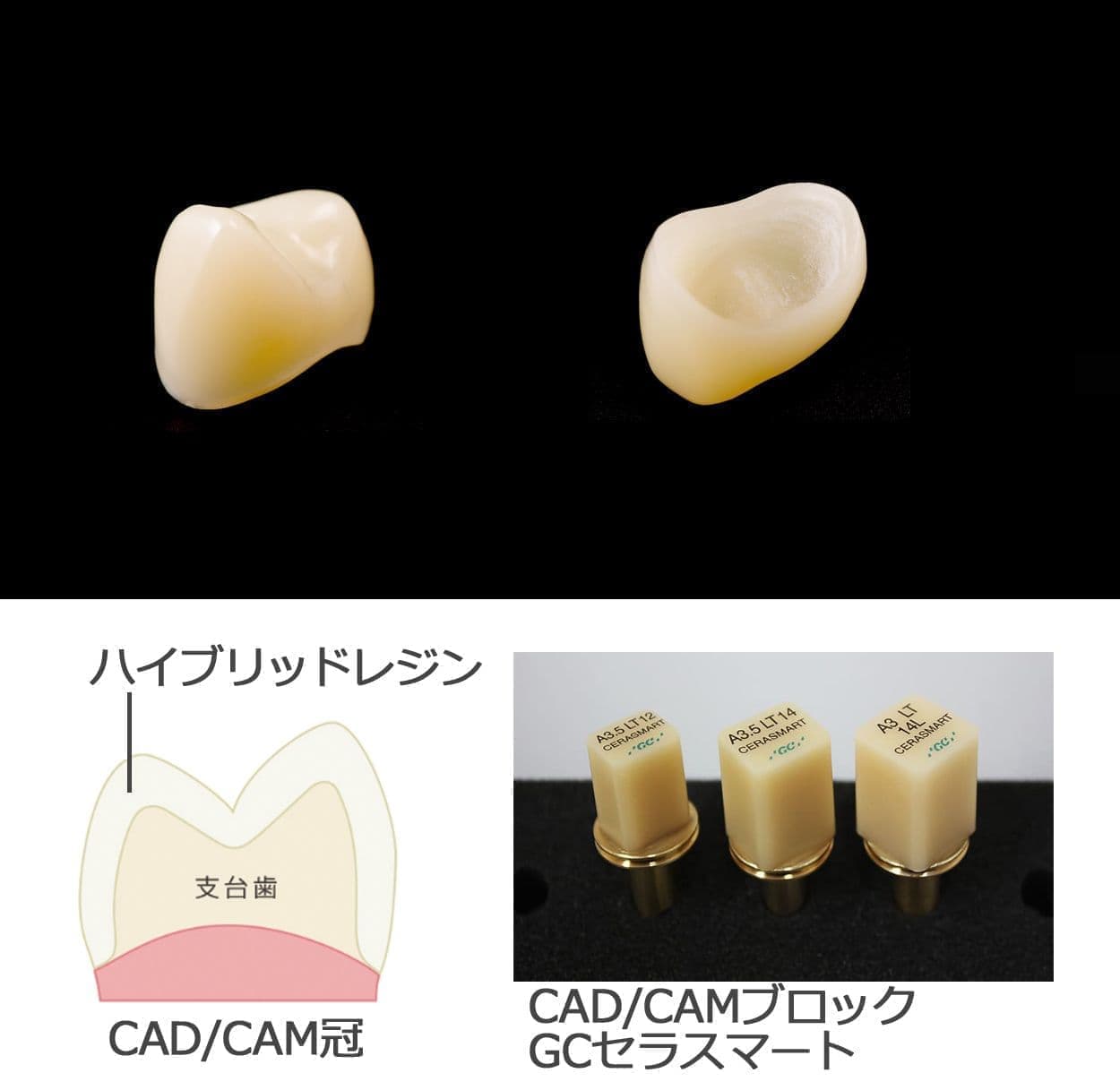 CAD/CAM冠
