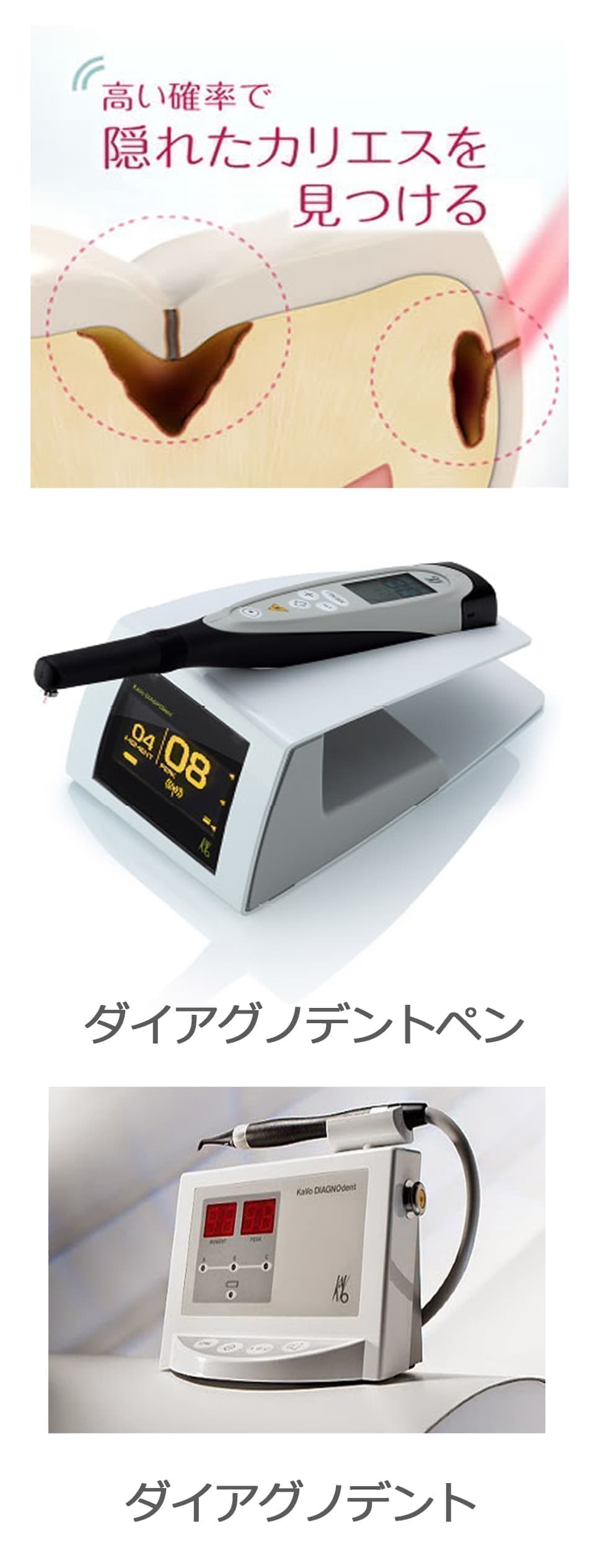 虫歯の早期発見