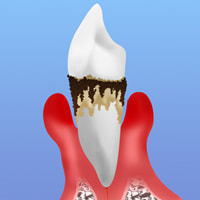 歯周病は早期発見早期治療が大切です